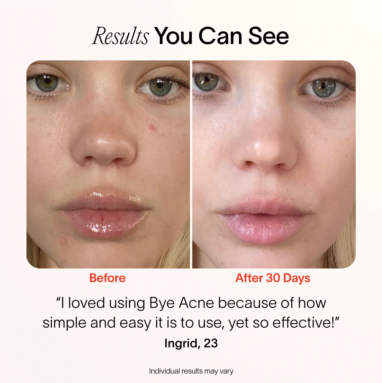 Bye Acne: 3-Minute Pimple Spot Treatment